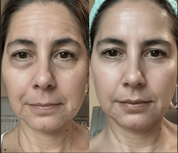 Retinal Shot. Olvídate de las Arrugas!