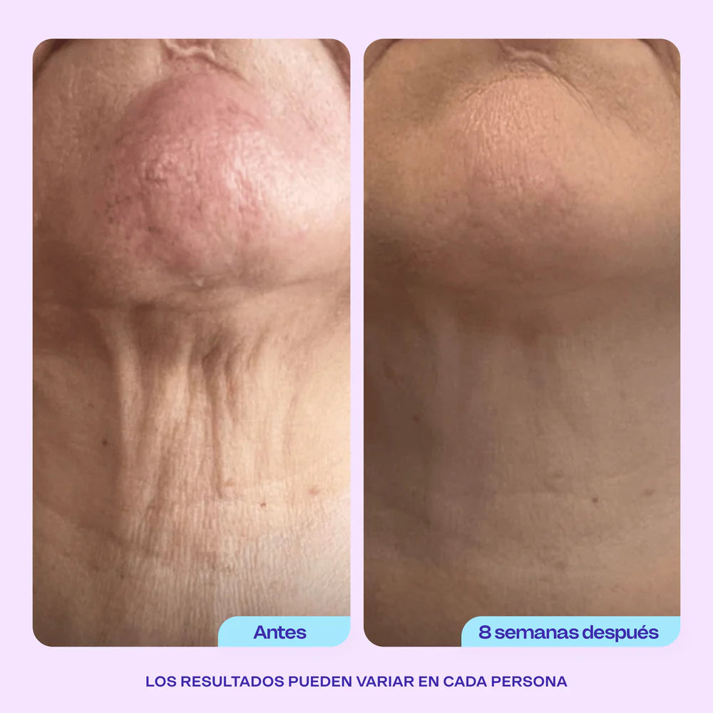 Crema Lifting Neck | Rejuvenece tu Cuello y Escote. Lleva 1 de regalo!
